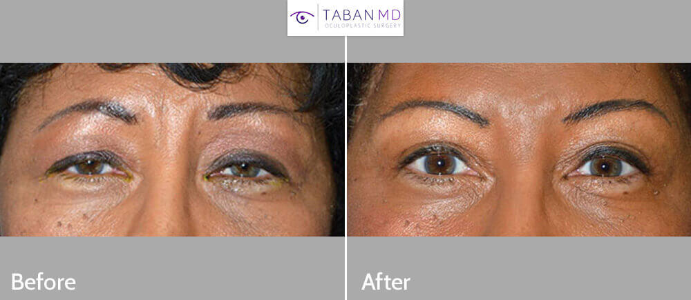 Middle age African-American female, complained of droopy saggy upper eyelids with tired eye appearance. She underwent bilateral upper eyelid ptosis repair (droopy eyelid surgery via muscle tightening), upper blepharoplasty (skin removal), and lateral pretrichial brow lift, to give more youthful natural eye appearance. Before and 3 months after cosmetic eyelid surgery postoperative photos are shown.