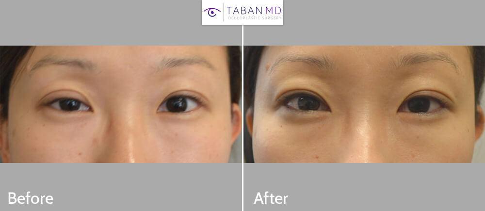 30 year old Asian female, with right upper eyelid ptosis (droopy eyelid) underwent internal (scar-less) right upper eyelid ptosis surgery. Before and 2 months after eyelid ptosis correction photos are shown.