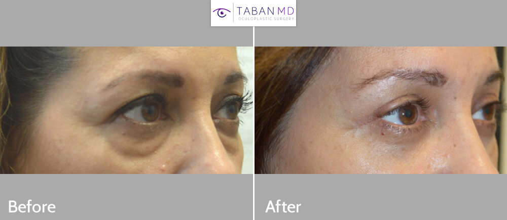 51 year old female, complained of looking tired and older due to saggy hooded upper eyelid and under eye bags and dark circles. She underwent upper blepharoplasty (eyelid lift), lower blepharoplasty (transconjunctival with fat repositioning and skin pinch removal) and lateral pretrichial brow lift (using temple hairline incision). Before and 3 months after cosmetic eyelid surgery photos are shown. Note natural rested eye appearance.