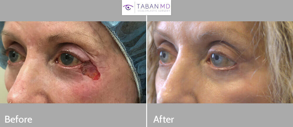 77 year old female, underwent Mohs surgery to remove large basal cell carcinoma from the eyelid and cheek, followed by eyelid reconstruction. Before and 3 months after eyelid skin cancer reconstruction photos are shown.