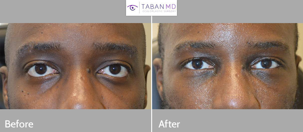 Young man, with genetic protruding eyes and sad tired eye appearance underwent cosmetic orbital decompression (bulging eye surgery), lower eyelid retraction surgery with canthoplasty (almond eye surgery) and infraorbital rim silicone implant. Note improved eye appearance.