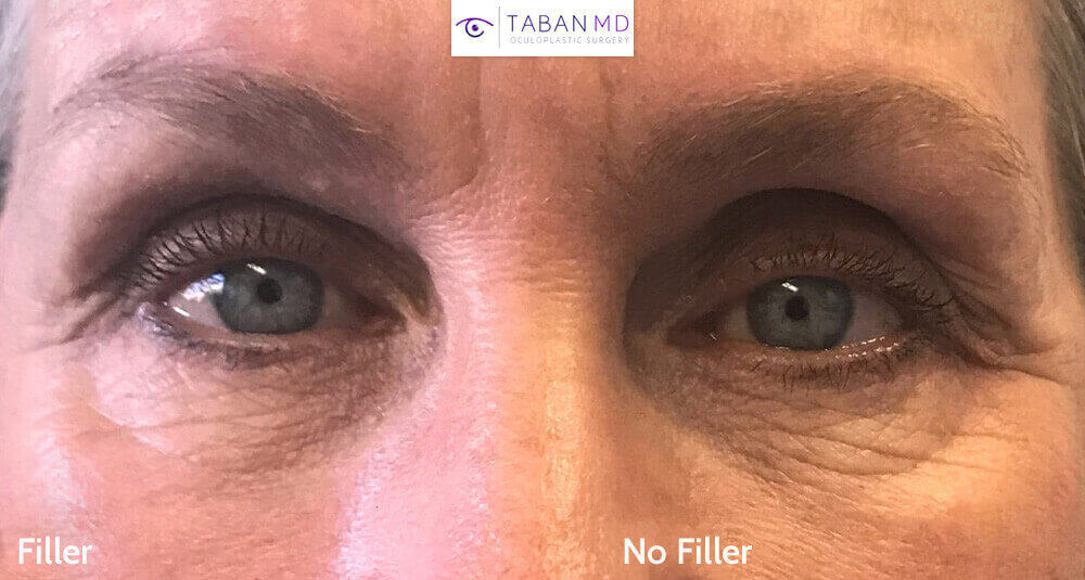 The youthful effect of upper eyelid filler in an older female patient.