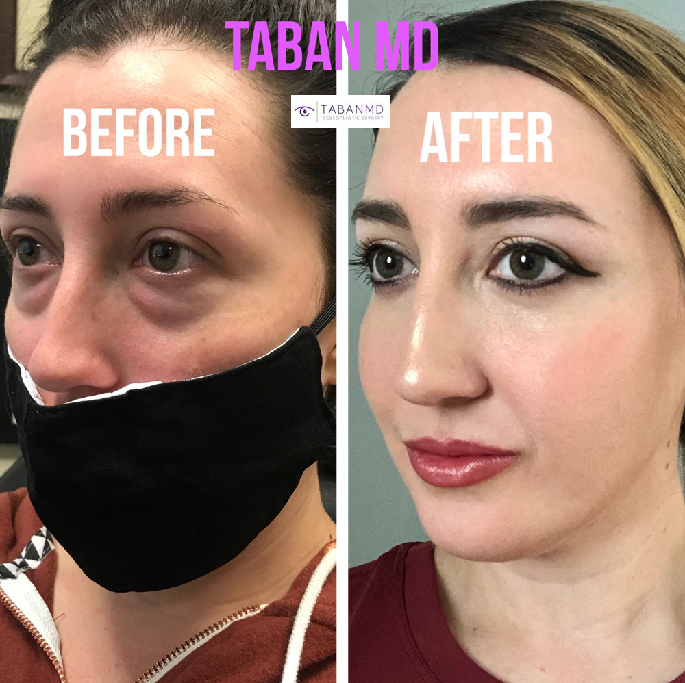 Beautiful woman with obvious under eye fat bags causing tired eyes, underwent scarless lower blepharoplasty (transconjunctival technique with eye fat bags repositioning). Her surgical video can be found on our website.