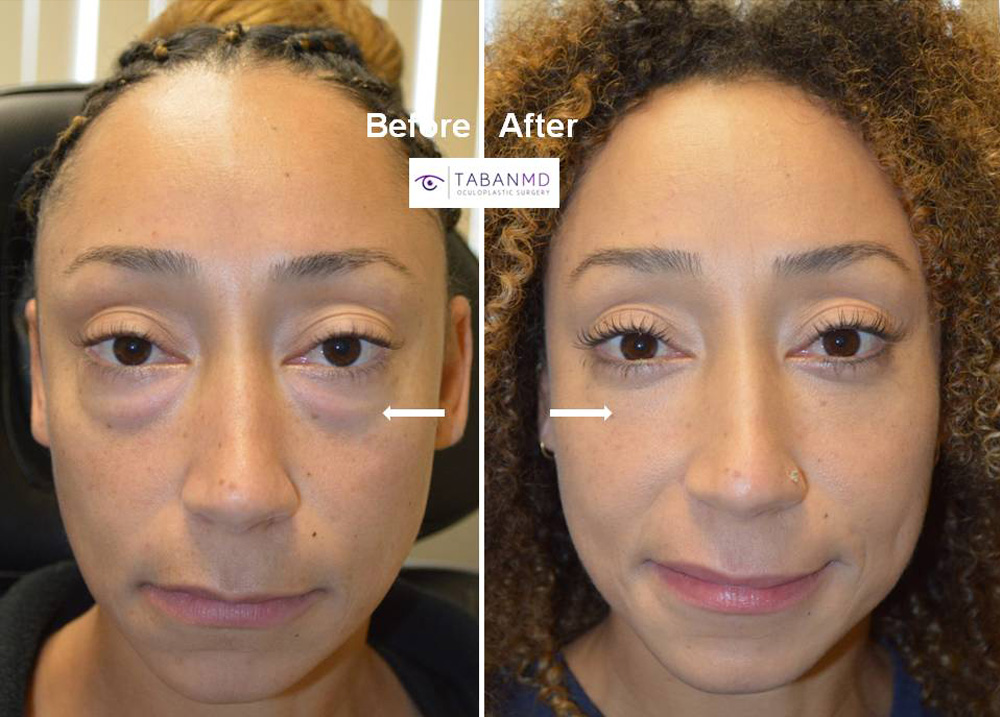 Famous athlete from Ninja Warrior TV show underwent scarless lower blepharoplasty to address genetic under eye fat bags. Here whole surgical video can be found on the website.