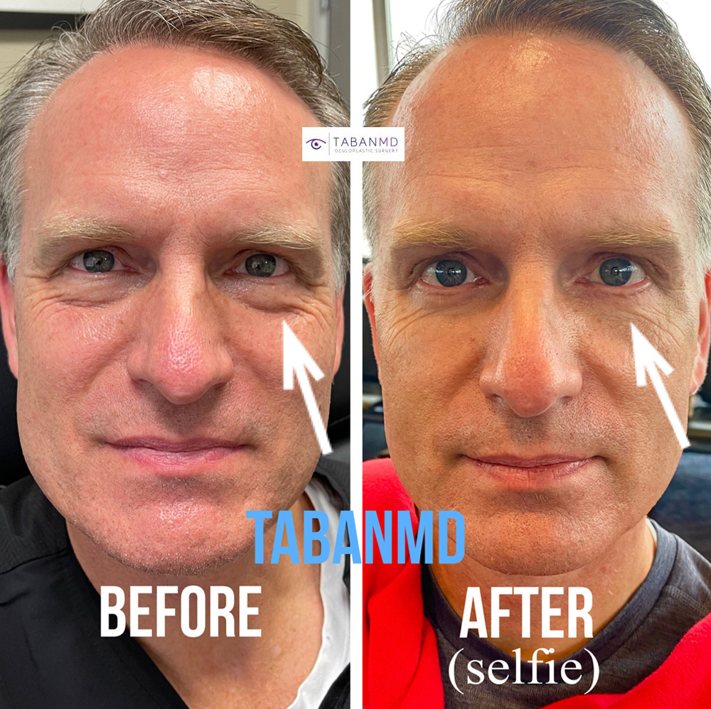 50+ year old ophthalmologist (Dr DeBry) with under eye fat bags, flew from Las Vegas to Los Angeles. He underwent lower blepharoplasty to improve under eye appearance. Note more youthful eye appearance. His surgical video can be found on our website.