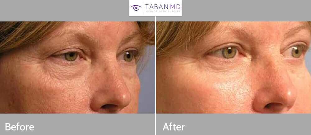 50 year old female, complained of extra loose, wrinkled skin around eyes. She underwent cosmetic upper blepharoplasty (skin removed from upper eyelids to correct hooded eyes), lower blepharoplasty (transconjunctival approach with fat redraping to correct under eye bags), and chemical peel (to tighten and smooth our find wrinkles around eyes), under local anesthesia in the office. Note natural results with patient’s eyes looking healthier, younger, and more rested. Before and 3 months after eye plastic surgery photos are shown.