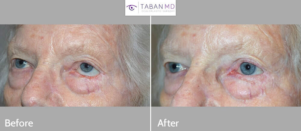 70+ year old female, with left lower eyelid retraction and inability to close her left eye (lagophthalmos) secondary to previous skin cancer surgery. She underwent total left lower eyelid reconstruction (using Hughs flap from the upper eyelid) and eyelid retraction surgery with skin graft. Preop and 3 months postoperative photos are shown.