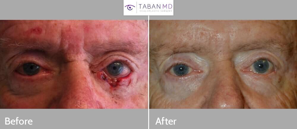 70+ year old male, with large left lower eyelid defect after Mohs procedure to remove eyelid skin cancer (basal cell carcinoma). He underwent left lower eyelid skin cancer reconstruction. Before and 3 months postoperative photos are shown.