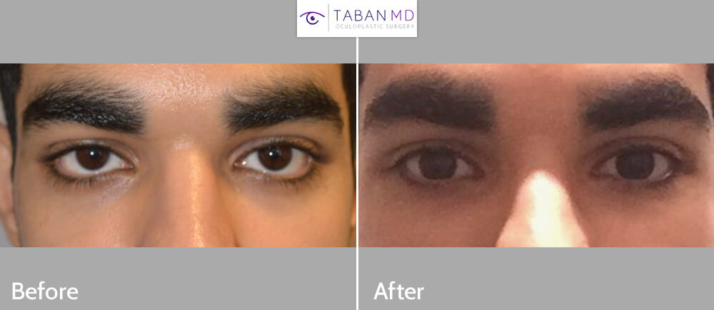 Young male, with inherited lower eyelid retraction and sclera show, underwent Almond Eye Surgery (lower eyelid retraction surgery with alloderm spacer graft, canthoplasty, tear trough implant) to give more attractive almond shaped eyes. Before and 3 months after surgery photos are shown.