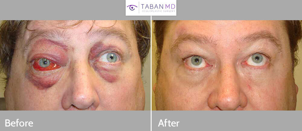 Middle age man with right orbital blow out fracture from a punch with inability to move the right eye up with double vision (diplopia). He underwent right orbital fracture repair with implant with restoration of eye movement. Preop and 6 weeks postoperative photos are shown.