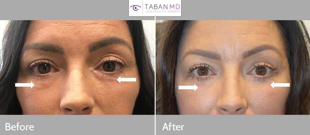 47 year old female, with history of fat injection under eyes creating lumps, underwent revision lower blepharoplasty with removal of injected fat lumps and granulomas. Before and 2 months after surgery photos are shown.