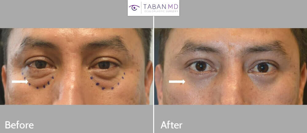 53 year old male, looking tired, underwent scarless transconjunctival lower blepharoplasty with eye fat repositioning to the hollow tear trough area (as depicted by dotted area). Before and 1 month after eyelid surgery photos are shown.