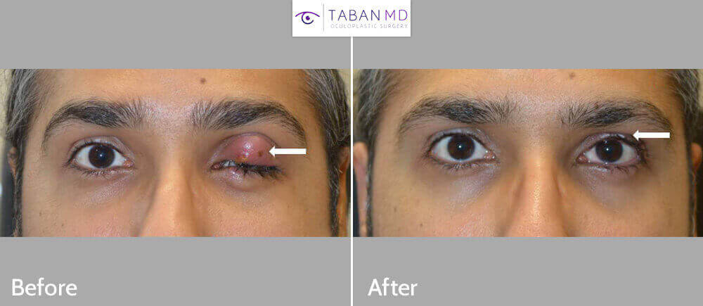 40+ year old man underwent removal of severe large infected left upper eyelid chalazion (stye).