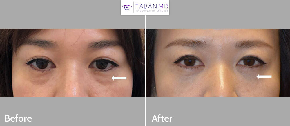38 year old Asian female, with under eye fat bags and tear trough hollowness, underwent scarless transconjunctival lower blepharoplasty with repositioning of the eye fat bags to the surrounding hollow area, creating more smooth under eyes with natural results. Before and 1 month after lower blepharoplasty photos are shown.