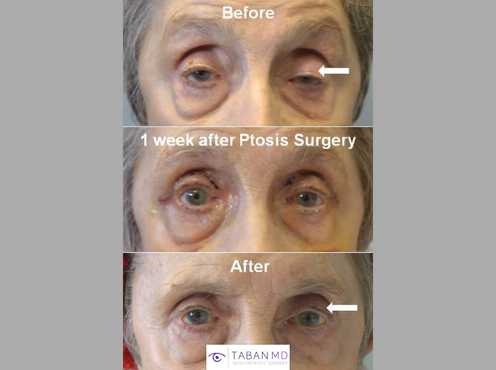 86 year old female, with severe age-related droopy upper eyelids (ptosis) underwent functional droopy upper eyelid surgery. Before, 1 week after, and 1 month after eyelid ptosis repair photos are shown.