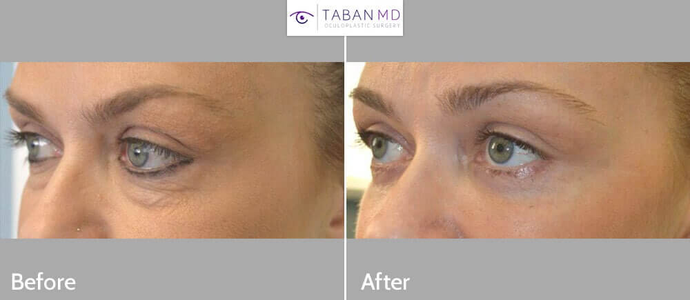 43 year old female, complained of under eye bags and wrinkles and dark circles. She underwent transconjunctival lower blepharoplasty (incision inside the lower eyelid) with fat bags repositioning to fill the hollow area below the bags, plus skin pinch technique to remove loose skin. Before and 6 weeks after cosmetic lower eyelid surgery photos are shown.