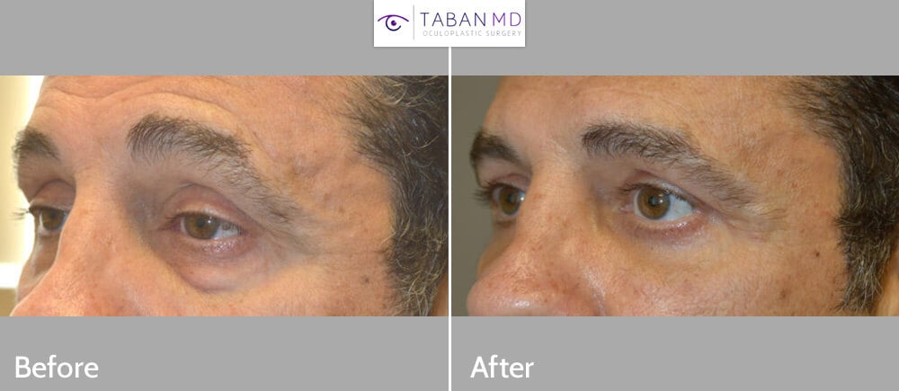 Middle age man, complained of looking tired and older. He underwent cosmetic eyelid procedures including lower blepharoplasty (transconjunctival with fat repositioning) to correct under eye bags, male upper blepharoplasty (skin only), and upper eyelid ptosis (droopy eyelid; eyelid lift) surgery. Before and 3 months after photos are shown, with natural results.