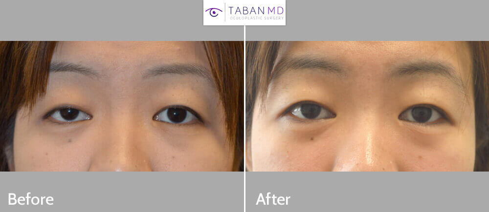Young Asian female, underwent RIGHT upper eyelid ptosis surgery, using internal scar-less technique.