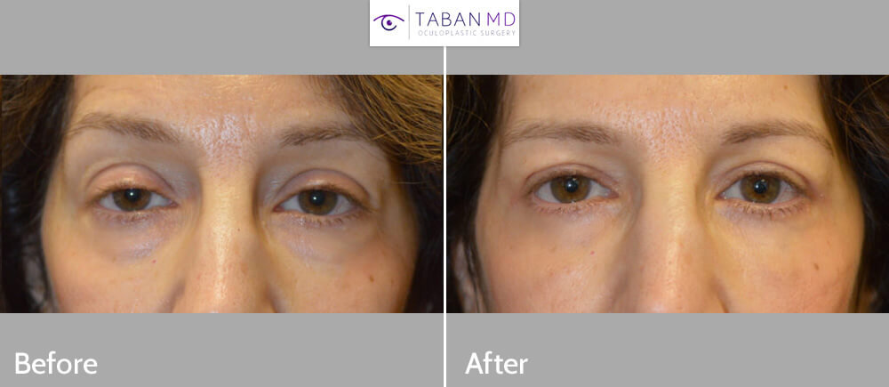 55 year old female, complained of looking tired and older. She underwent cosmetic eyelid procedures including lower blepharoplasty (transconjunctival with fat repositioning) to correct under eye bags, upper blepharoplasty (skin only), and upper eyelid ptosis (droopy eyelid; eyelid lift) surgery. Before and 3 months after photos are shown, with natural results.
