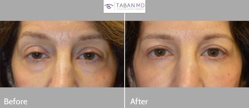 55 year old female, complained of looking tired and older. She underwent cosmetic eyelid procedures including lower blepharoplasty (transconjunctival with fat repositioning) to correct under eye bags, upper blepharoplasty (skin only), and upper eyelid ptosis (droopy eyelid; eyelid lift) surgery. Before and 3 months after photos are shown, with natural results.