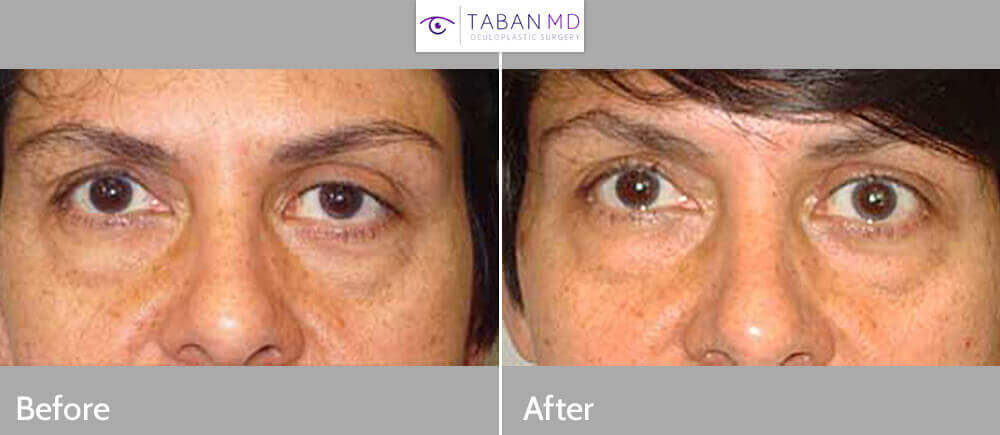 Revisional Ptosis Treatment by Los Angeles Surgeon