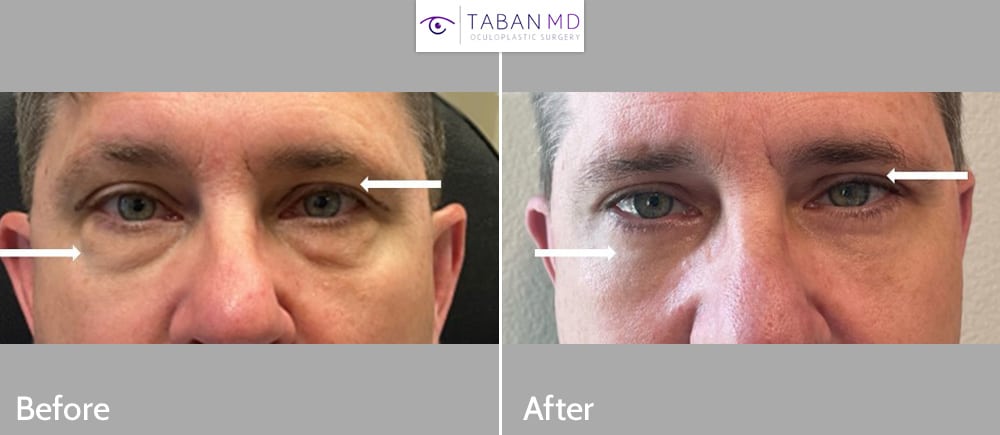 Middle aged man, a neurosurgeon with eyelid aging and tired appearing eyes, underwent lower blepharoplasty (transconjunctival technique with eye fat repositioning and skin pinch) and conservative male upper blepharoplasty.