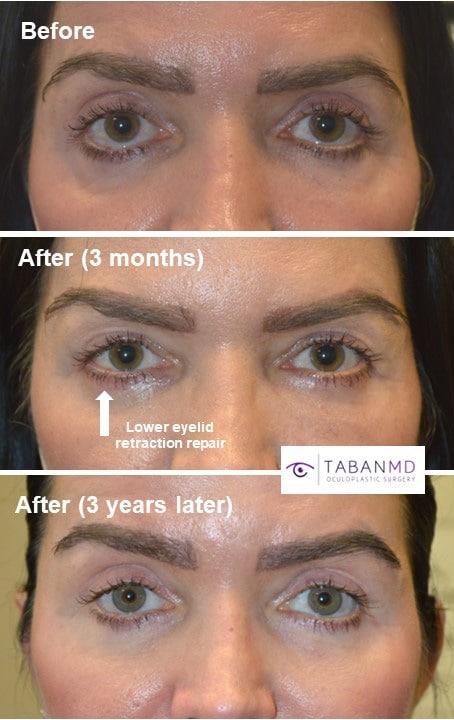 Short and long term results of woman who underwent lower eyelid retraction repair which had resulted from botched lower blepharoplasty.