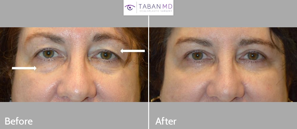 Middle aged woman, with eyelid aging and tired eyes, underwent quad-blepharoplasty (upper blepharoplasty and lower blepharoplasty). Before and 3 months after photos are shown.