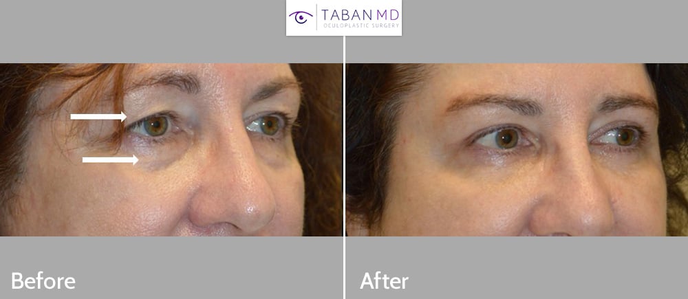 Middle aged woman, with eyelid aging and tired eyes, underwent quad-blepharoplasty (upper blepharoplasty and lower blepharoplasty). Before and 3 months after photos are shown.