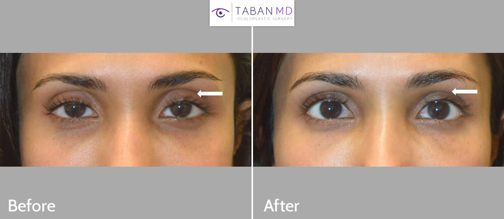 Young woman with deep sunken upper eyelids underwent upper eyelid sulcus filler injection. Note more youthful results.