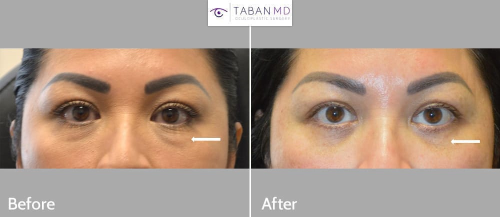 Middle age woman with tired appearing eyes underwent lower blepharoplasty (transconjunctival technique with shifting of eye fat bags plus skin pinch).