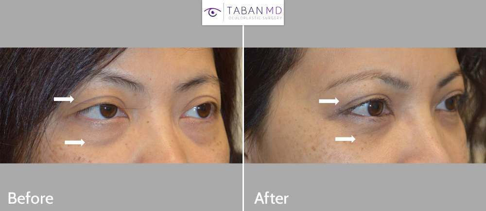 Young Asian woman underwent Asian upper blepharoplasty and scarless lower blepharoplasty (transconjunctival technique with fat repositioning to tear trough area).