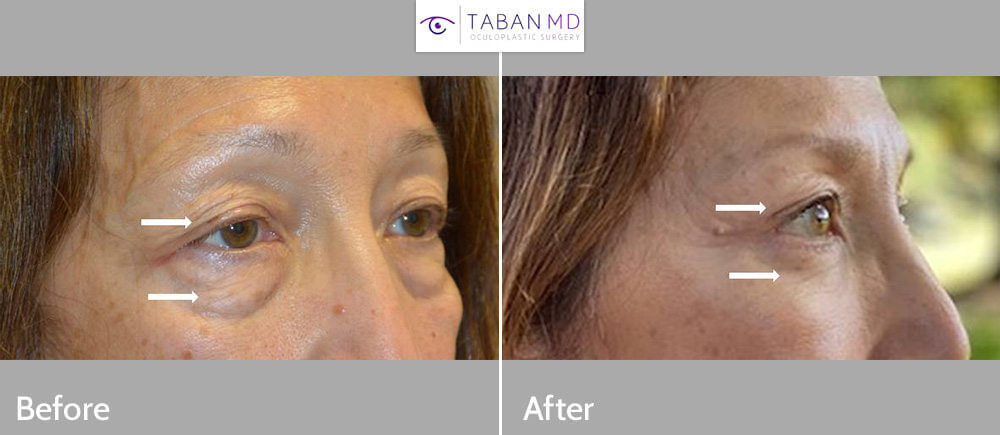 60+ year old woman underwent upper blepharoplasty (eyelid lift) and lower blepharoplasty. Her before and after selfie photos are shown.