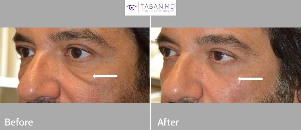 Middle aged gentleman, underwent customized male upper blepharoplasty, lower blepharoplasty, and direct festoons excision. Note overall rested eye/facial appearance and improved eye symmetry.