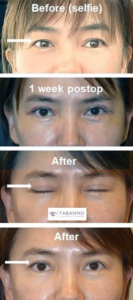 Middle age woman underwent customized Asian upper blepharoplasty (double eyelid surgery).