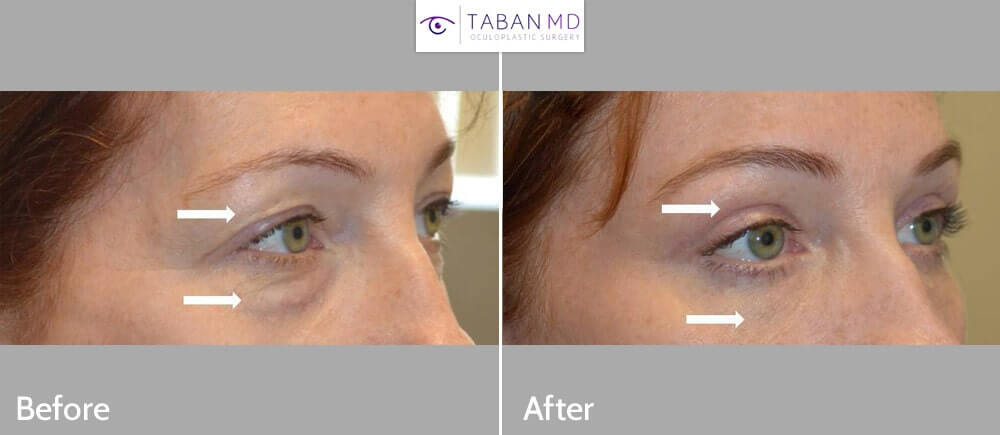 46 year old woman, looking tired and older, underwent upper blepharoplasty and lower blepharoplasty (transconjunctival technique with fat repositioning and skin pinch). Note more youthful results.