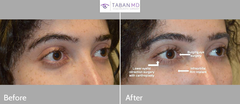 Young transgender female underwent eye reshaping surgery to have less bulging and more uptured almond eyes. Procedure included scarless orbital decompression, lower eyelid retraction surgery with canthoplasty (almond eye surgery), and customized infraorbital rim silicone implant.