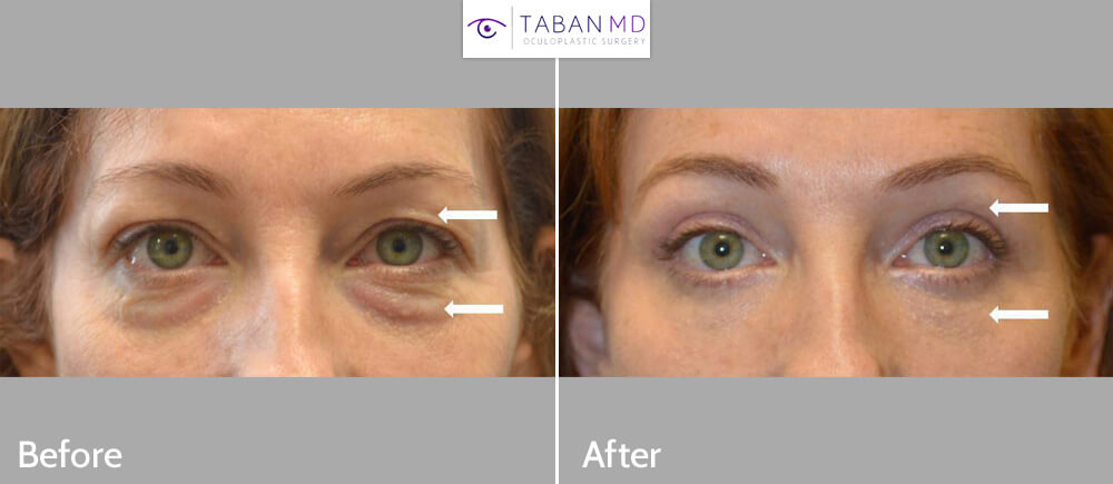 46 year old woman, looking tired and older, underwent upper blepharoplasty and lower blepharoplasty (transconjunctival technique with fat repositioning and skin pinch). Note more youthful results.