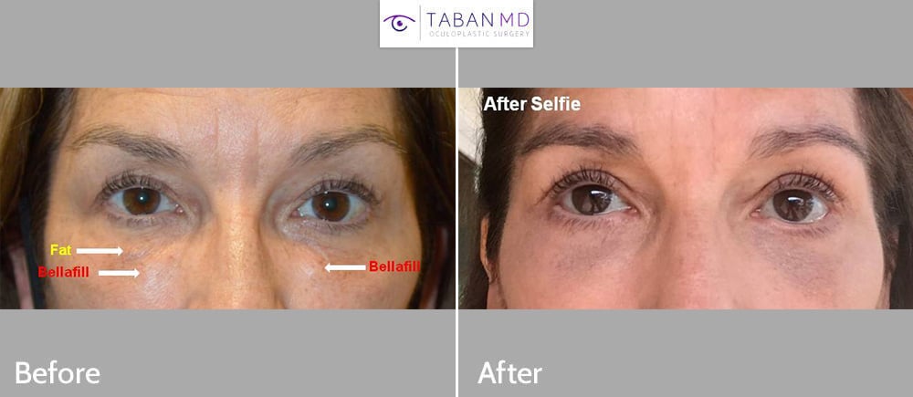 60+ year old woman, with under eye lumpiness from Bellafill injection (done by another doctor) underwent complex lower blepharoplasty with removal of the Bellafill.