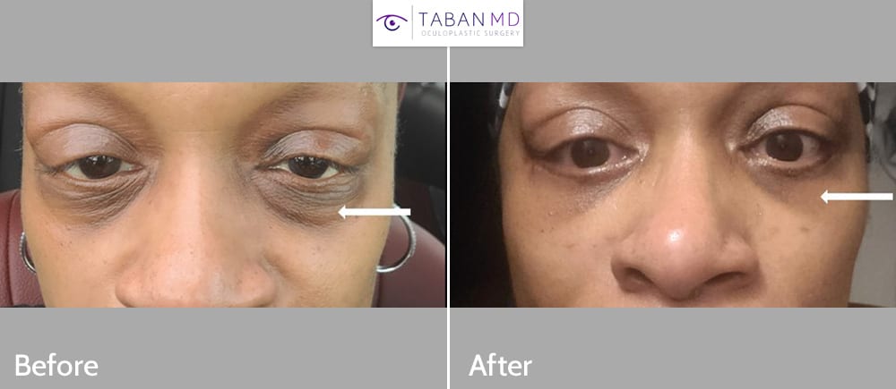 Middle aged African American woman underwent lower blepharoplasty (transconjunctival approach with eye fat bags repositioning and skin pinch).