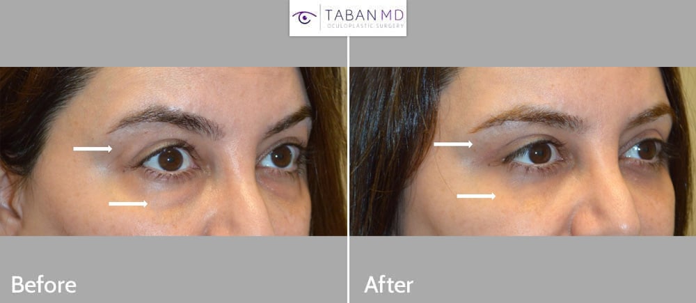 Middle age woman underwent upper blepharoplasty, lacrimal gland repositioning (for lacrimal gland prolapse) and scarless lower blepharoplasty.
