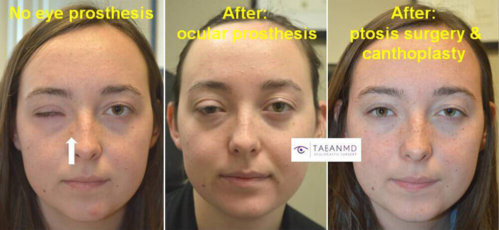 18 year old young brave woman, underwent revision of her right ocular prosthesis (by ocularist) plus right upper eyelid ptosis surgery and right canthoplasty.