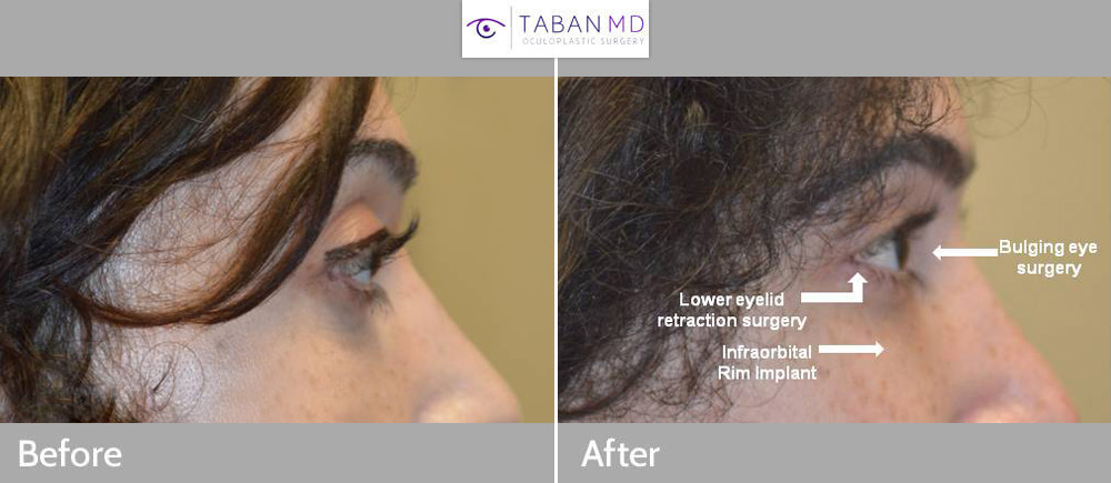 Young transgender female underwent eye reshaping surgery to have less bulging and more uptured almond eyes. Procedure included scarless orbital decompression, lower eyelid retraction surgery with canthoplasty (almond eye surgery), and customized infraorbital rim silicone implant.
