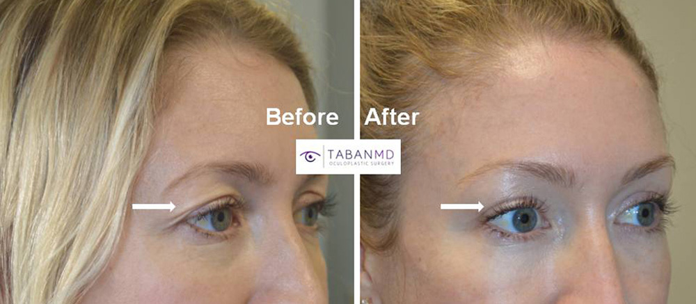 39 year old beautiful woman, with upper eyelid aging due to loose skin folds and fat loss, underwent combined upper blepharoplasty and upper eyelid filler injection. Before and 6 months after cosmetic eyelid surgery photos are shown.