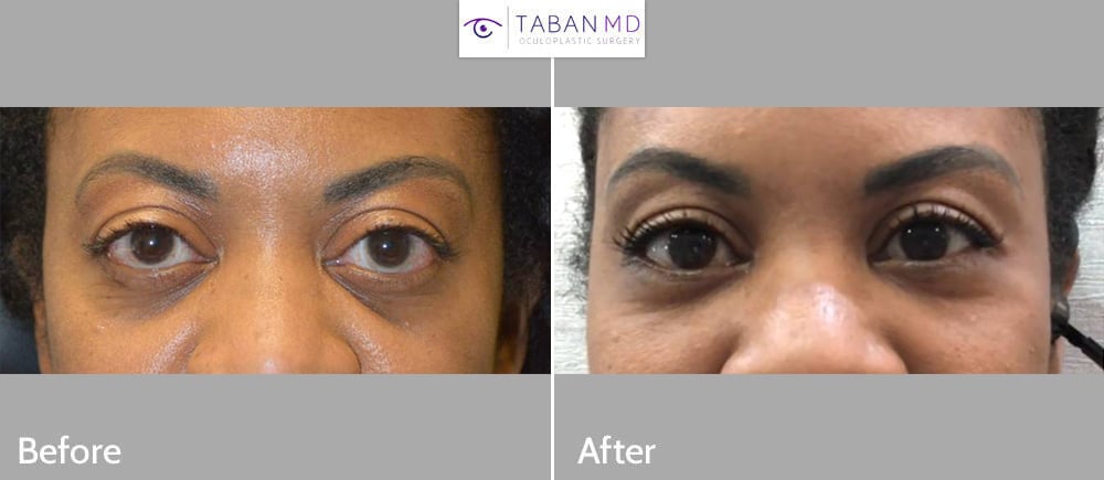 40+ year old female, with genetic bugling eyes, underwent cosmetic orbital decompression, customized infraorbital rim silicone implant, and lower eyelid retraction surgery with canthoplasty.