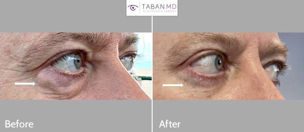 Middle aged man, dentist who traveled from Ireland to Los Angeles, with eyelid aging and congenital negative vector eye anatomy, underwent lower blepharoplasty and conservative male upper blepharoplasty. His before and after selfie photos are shown.