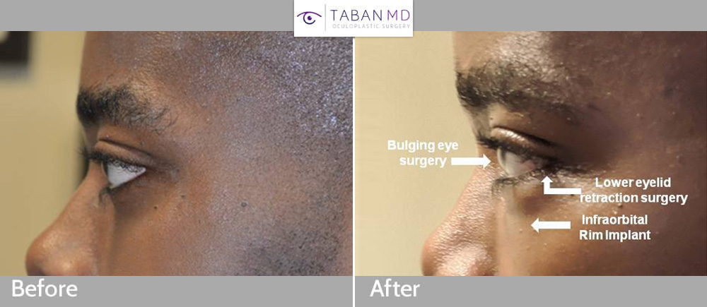 30 year old African American man, with congenital droopy lower eyelids (lower eyelid retraction with negative canthal tilt) and bulging eyes and maxillary hypoplasia with sad tired eye appearance, underwent lower eyelid retraction surgery with canthoplasty, scarless orbital decompression bulging eye surgery, and infraorbital rim silicone implant. His before and after selfie photos are shown. Note change to more almond shaped, upturned eye appearance with positive canthal tilt.