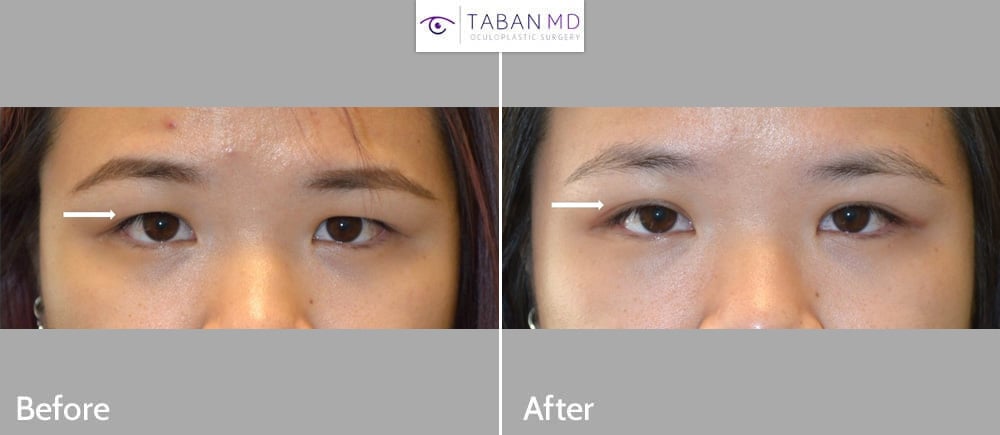Young Asian woman underwent customized Asian upper blepharoplasty (double eyelid surgery).