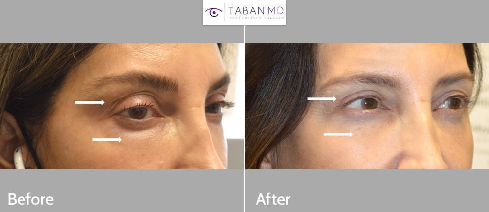Middle age woman, with eyelid aging and history of under eye fillers, underwent lower blepharoplasty, upper blepharoplasty, and droopy eyelid ptosis surgery.