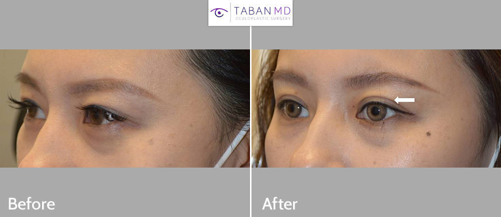 Young Asian female underwent Asian upper blepharoplasty. She wanted relatively aggressive blepharoplasty with more eyelid showing. Upper blepharoplasty is customized to each individual anatomy and desired goal.